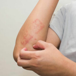 Here’s all that you need to know about scabies skin rash