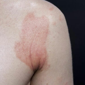 Contact Dermatitis – Symptoms, Causes, and Treatment Options
