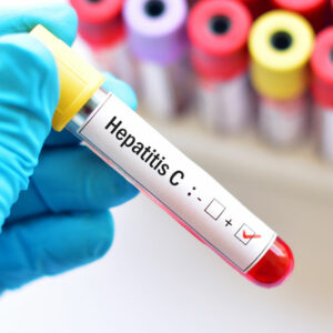 Hepatitis – types and contributing factors